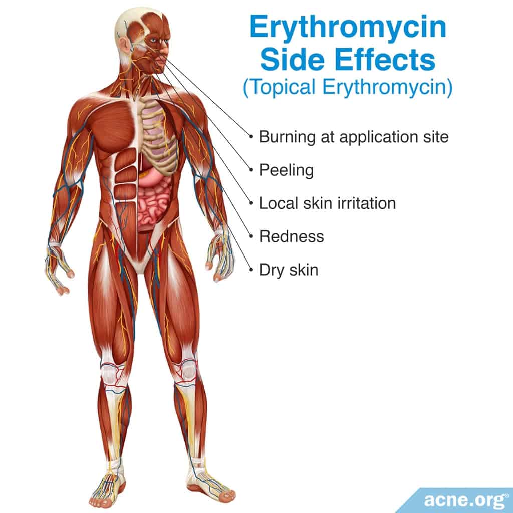 What is a Real Allergic Reaction to Erythromycin?