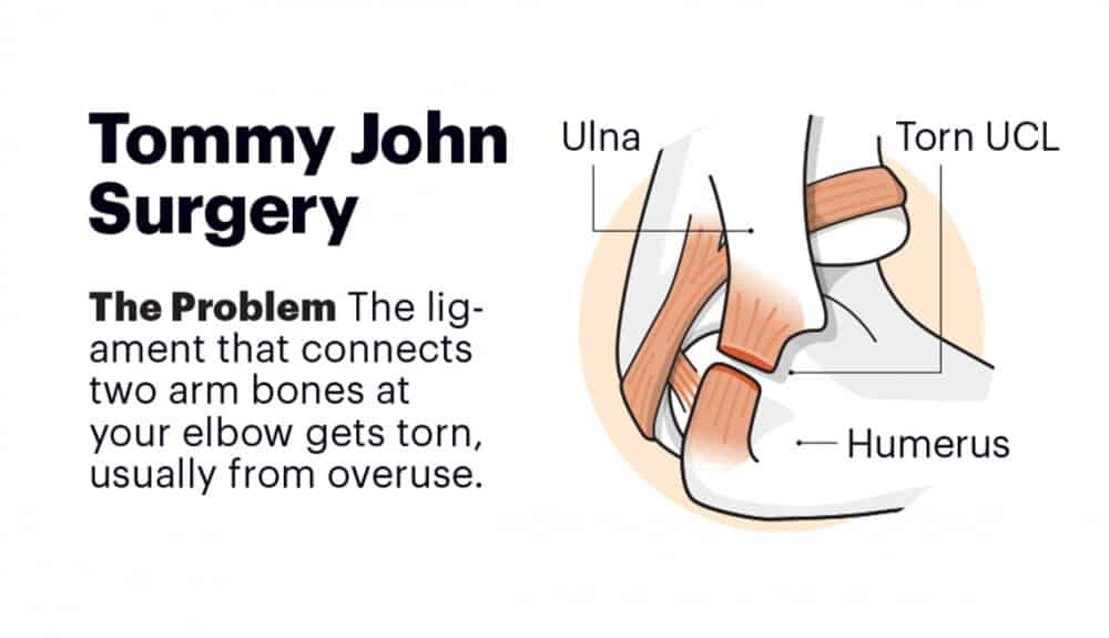 tommy john surgery before