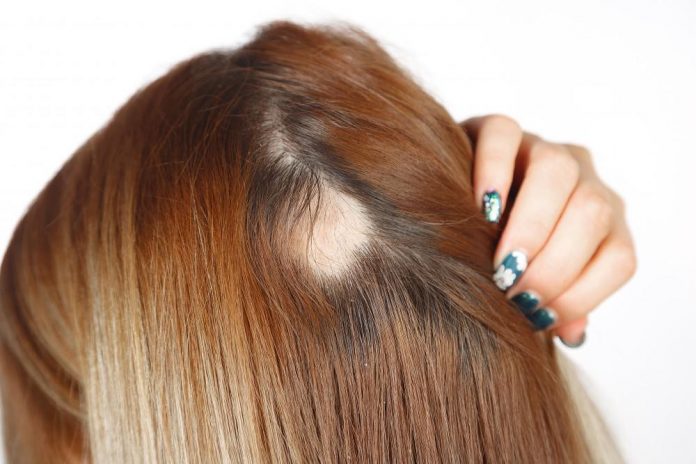 What is Alopecia? Popular Alopecia Areata Treatments