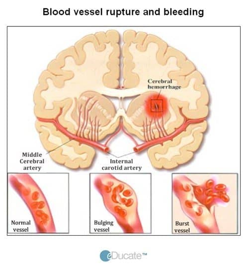 lightbox image showing blood vessel rupture and bleeding e