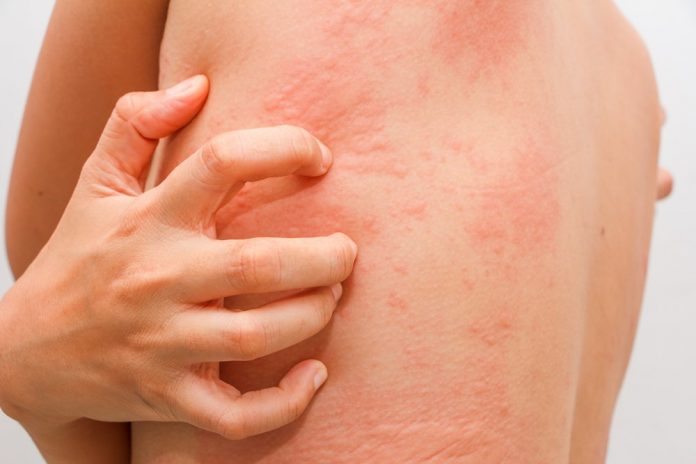 What is a Real Sulfa Drug Allergic Reaction?
