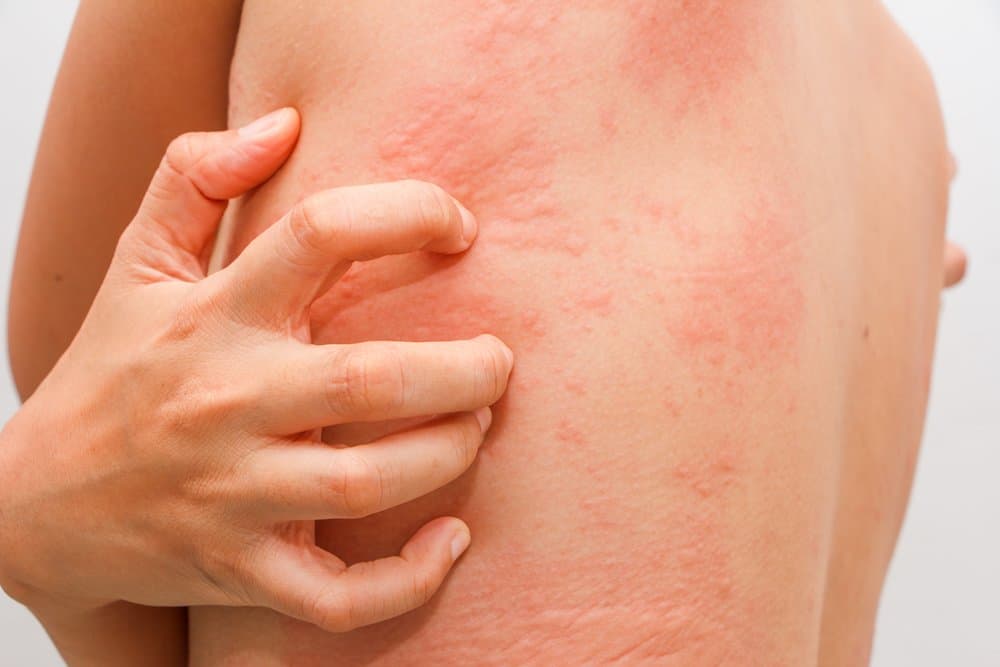 What is a Real Sulfa Drug Allergic Reaction?