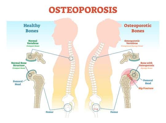What is Osteoporosis? Health Implications of Eating Disorders