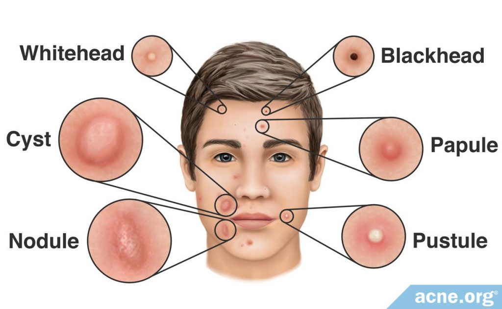 What Is Acne An Overview of Acne Development