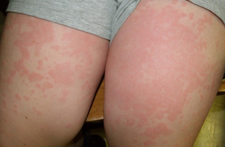 allergic reaction rash