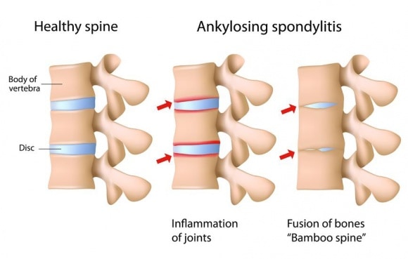 ankylosing spondylitis M