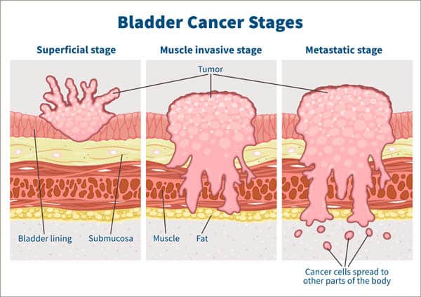 bladder cancer stages web