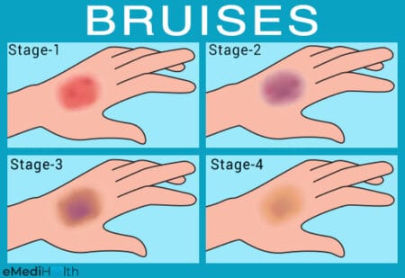bruises