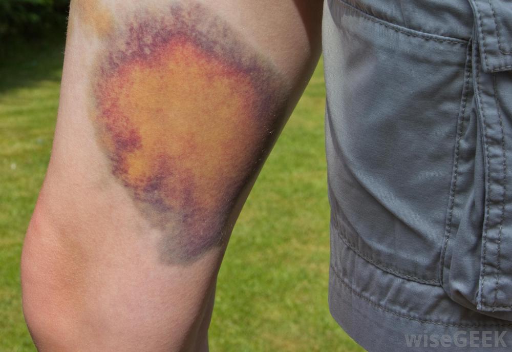 deep bruise on persons leg