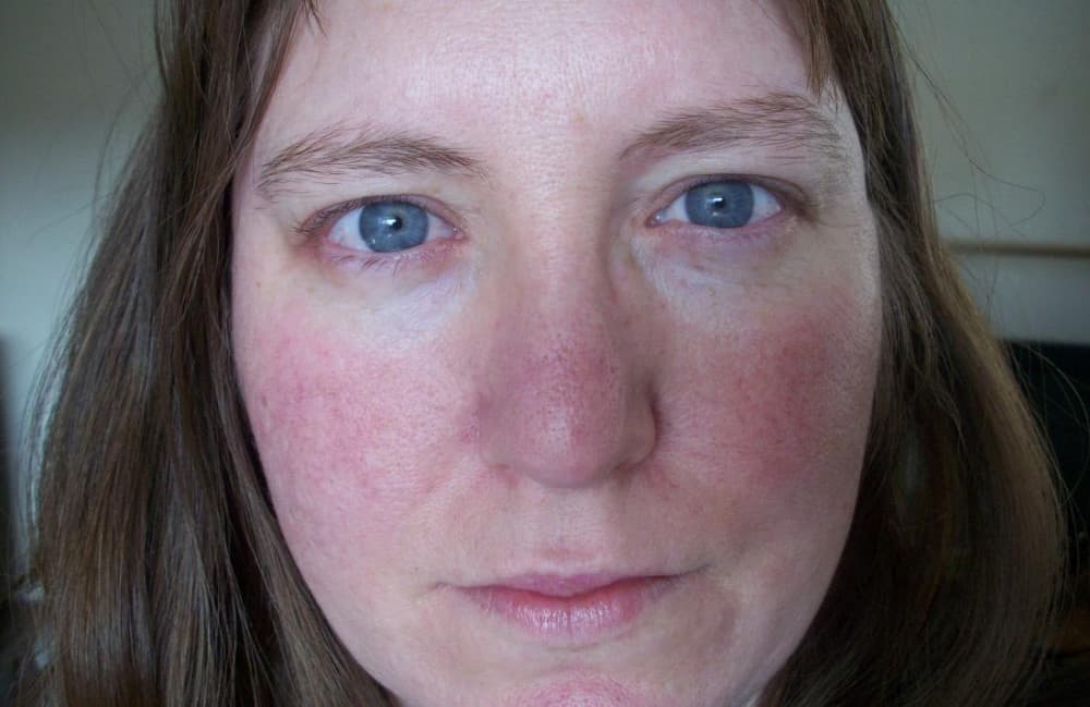 flushed or red skin on womans face image credit alisha vargas