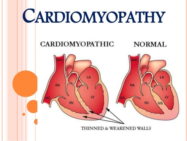 heart muscle disease cardiomyopathy