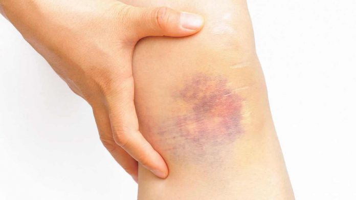 how to heal a bruise