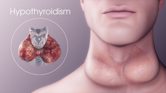 hypothyroidism about