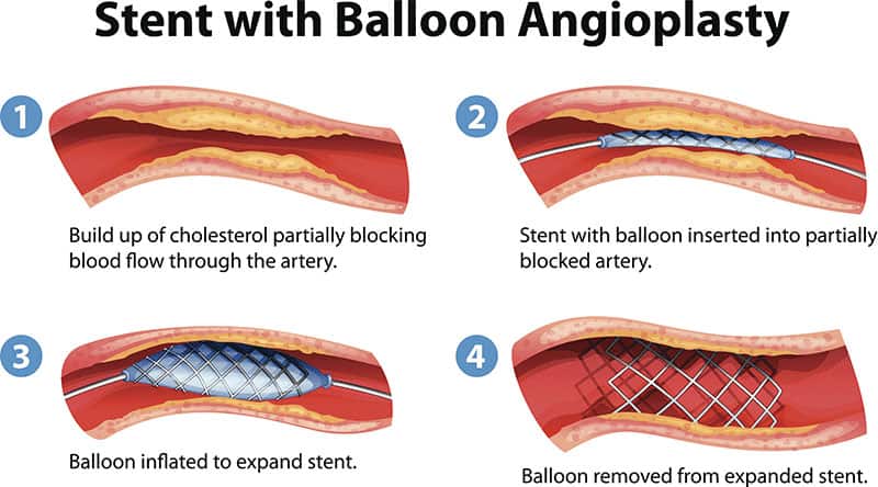 illustration of what is an angioplasty