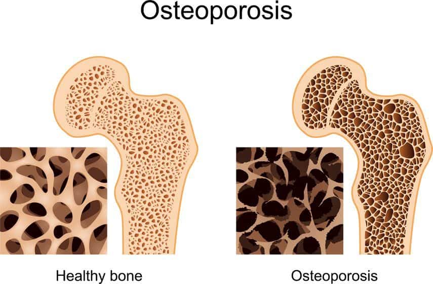osteoporosis M