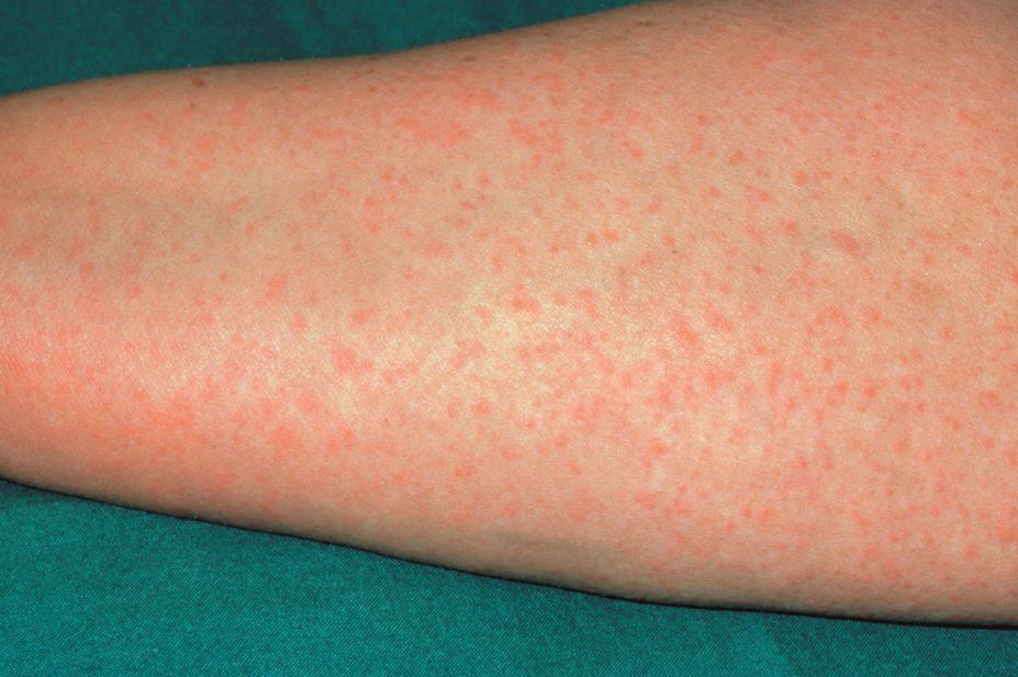 penicillin allergy on forearm
