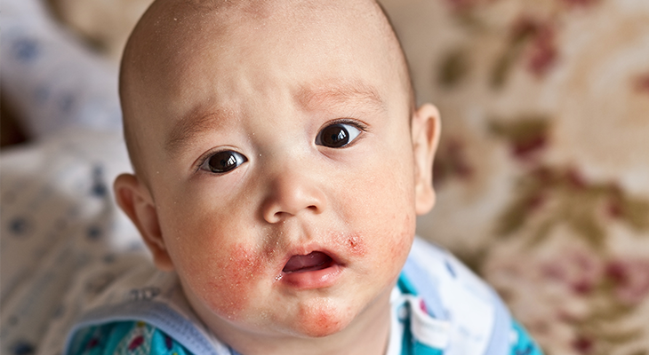 stock photo baby with eczema on face