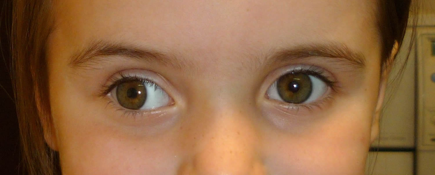 strabismus child