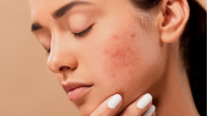 what is acne treatment reasons and solutions