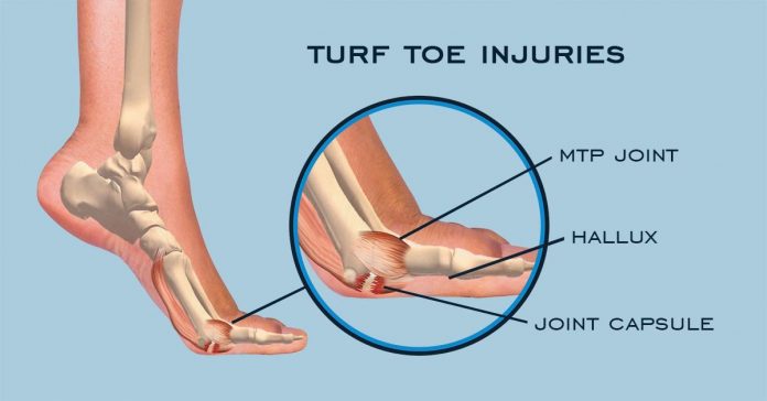Turf Toe Injuries