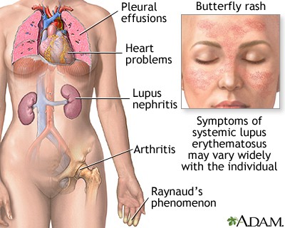 What is Lupus Syndrome: Features and Management of This Autoimmune Disorder