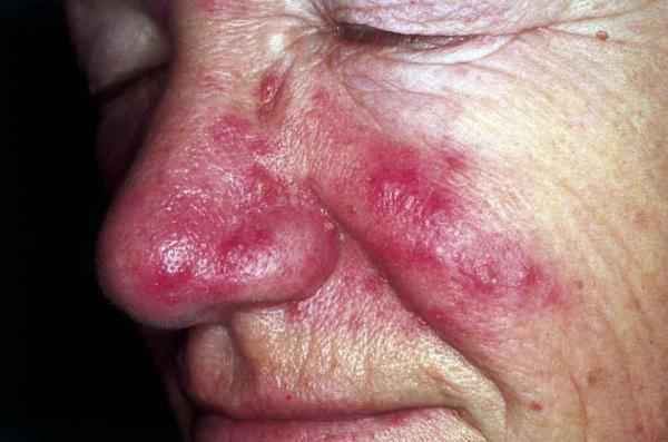Rosacea Wikipedia Commons