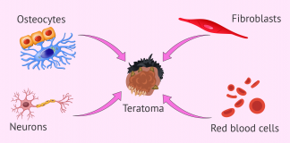 What are teratomas composed of