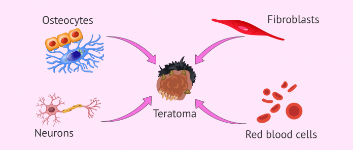 What are teratomas composed of