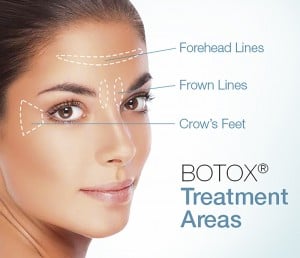 botox areas
