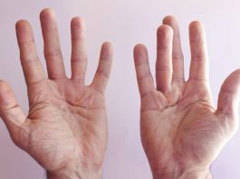 dupuytrens contracture symptoms and treatments chicagoland