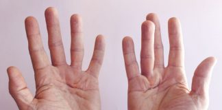 dupuytrens contracture symptoms and treatments chicagoland