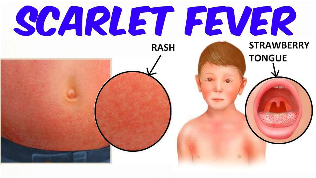 What Is Scarlet Fever Definition History And Symptoms
