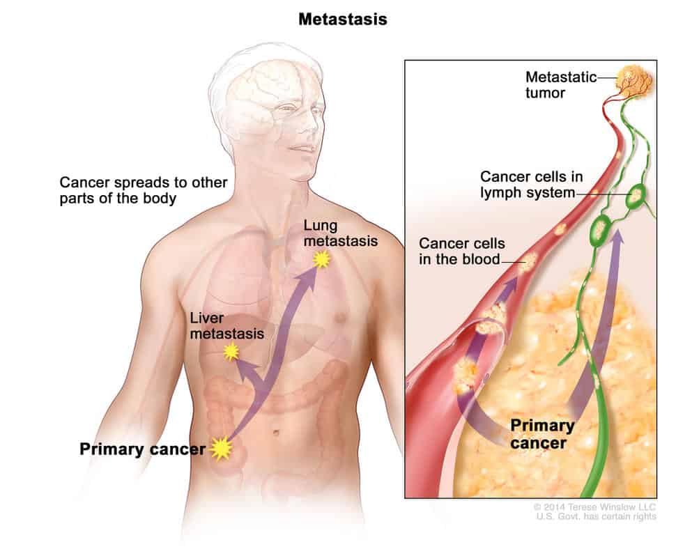 metastasis enlarge