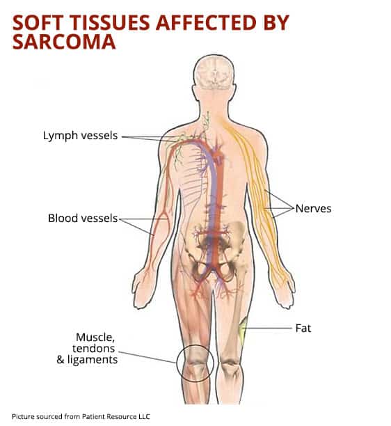sarcoma overview diagram