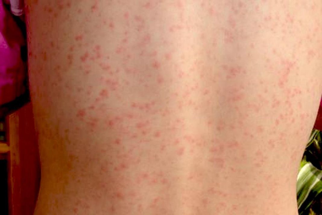 what-is-scarlet-fever-definition-history-and-symptoms