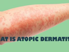 what is eczema atopic dermatitis symptoms causes diagnosis treatment prevention