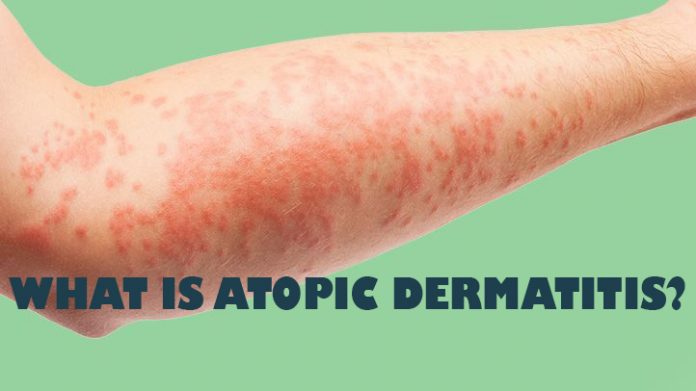 what is eczema atopic dermatitis symptoms causes diagnosis treatment prevention